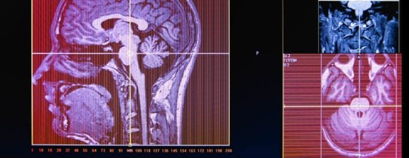 缺碘症患者癫痫发作(五大致命疾病之一)后进行的脑部扫描